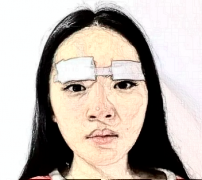 2022北京协和医院双眼皮怎么样?双眼皮案例分享