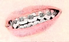 关于牙套那些事儿，牙齿矫正经历分享