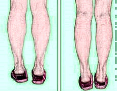 小腿吸脂后遗症有哪些?小腿吸脂手术后多久可以运动?