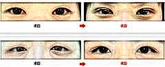 埋线双眼皮能维持几年?做埋线双眼皮能永久保持吗?