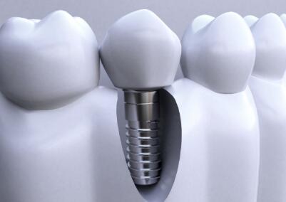 种植牙寿命是多少年?种植牙能管多久?保持多长时间?