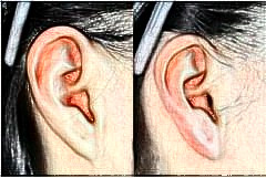 玻尿酸填充耳垂能维持多久?打玻尿酸填充耳垂可以管多久?