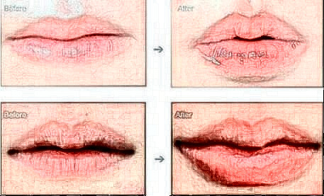 丰唇手术几天可以恢复自然?丰唇手术恢复需要多长时间?