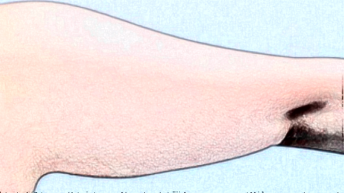 手臂吸脂后肿胀期是多久?手臂吸脂后手肿的厉害怎么办?