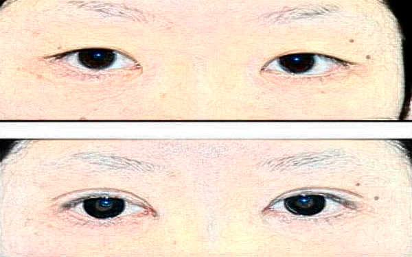 宁波第二医院割双眼皮怎么样?附胡文波医师双眼皮成形术案例及价格