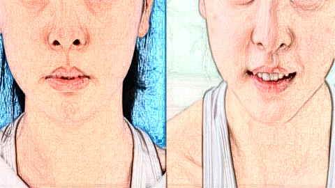 面颊吸脂恢复过程是怎样?恢复图展示