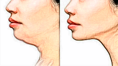 下颌缘提升会瘦脸么?脸能瘦吗?下颌缘提升脸会变小吗?