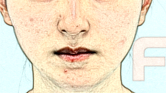 提升针会导致脸部塌陷吗?打提升针会造成脸部凹陷吗?