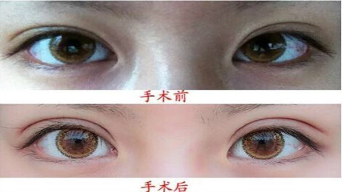 上海九院张波双眼皮手术做的怎么样?九院张波割双眼皮案例及价格