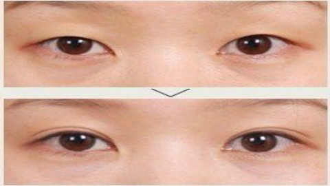 上海九院张波双眼皮手术做的怎么样?九院张波割双眼皮案例及价格