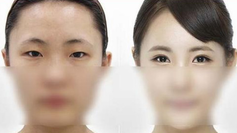 上海九院做双眼皮恢复怎么样?双眼皮修复哪个医生比较好?附案例