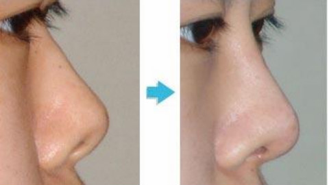 上海美莱鼻部修复专家韩国栋做鼻修复怎么样?附鼻修复案例