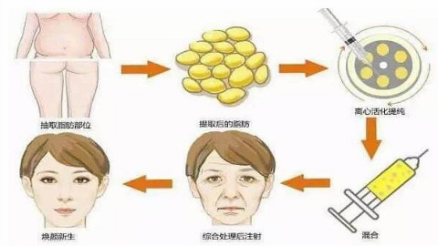 上海九院张路脂肪填充怎么样?面颊脂肪填充案例,减龄少女脸!