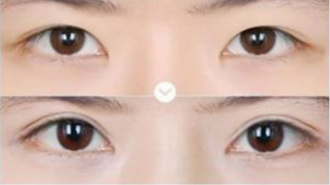 济南美莱韩旭双眼皮做的怎么样?韩超医生做双眼皮怎么样?附案例