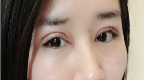 武汉美莱的刘扬做双眼皮怎么样?双眼皮手术案例及价格