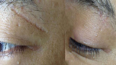 激光祛疤可以恢复到什么程度?多久才能恢复成肤色?