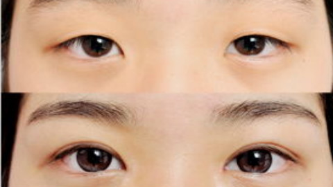 上海美莱双眼皮鲁医生做的怎么样?做双眼皮手术案例及价格 