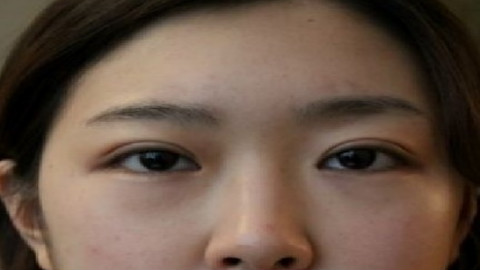 新疆医学院做双眼皮怎么样?双眼皮医生哪个割的好?附案例