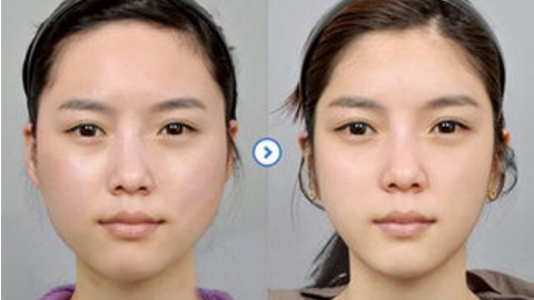 上海首尔丽格石润磨骨怎么样?石润磨骨改脸型手术案例及价目表