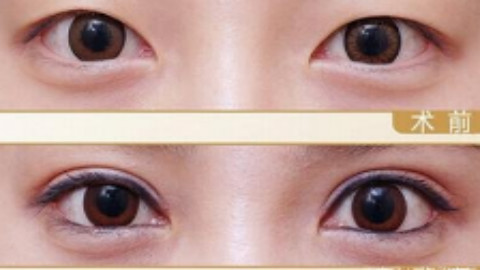 北京做双眼皮修复医院哪家好?北京埋线双眼皮修复医院排名推荐