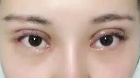 美莱刘晓荣做双眼皮怎么样?刘晓荣双眼皮手术案例及价格