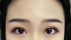 北京美莱王鹤做双眼皮怎么样?双眼皮手术案例及