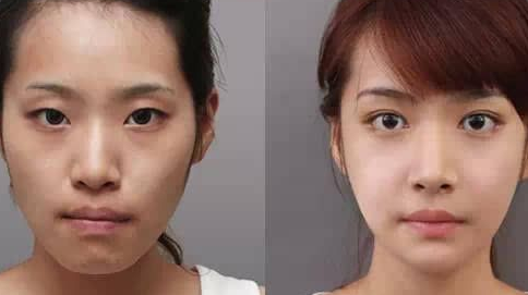 长沙凯莱刘凯鼻修复怎么样?隆鼻修复手术案例,美鼻不是梦!