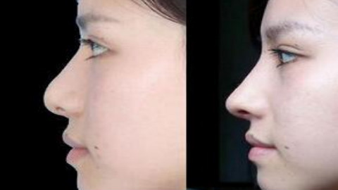 安医大赵宇鼻修复怎么样?自体软骨隆鼻修复案例,终于有美美的鼻!