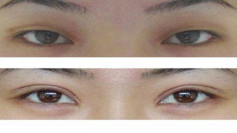 温州双眼皮修复哪个医生比较好?温州双眼皮修复专家排名名单推荐