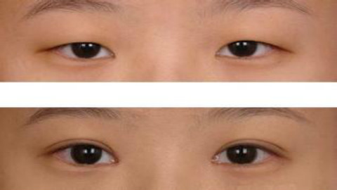 温州做双眼皮修复医院哪家好?温州埋线双眼皮修复医院排名推荐