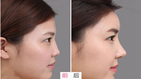 上海薇琳曹芳做鼻修复怎么样?肋软骨隆鼻修复案例,人有活力了!