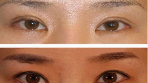 海口双眼皮修复哪个医生比较好?海口双眼皮修复专家排名名单推荐