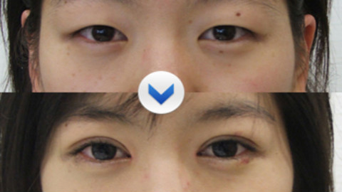 武汉双眼皮修复哪个医生比较好?武汉双眼皮修复专家排名名单推荐