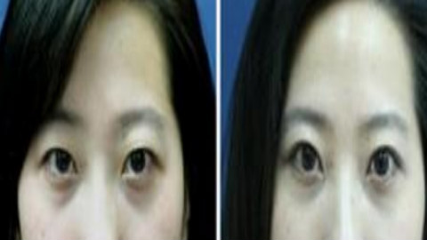 齐齐哈尔双眼皮修复哪个医生比较好?齐齐哈尔双眼皮修复专家排名名单推荐