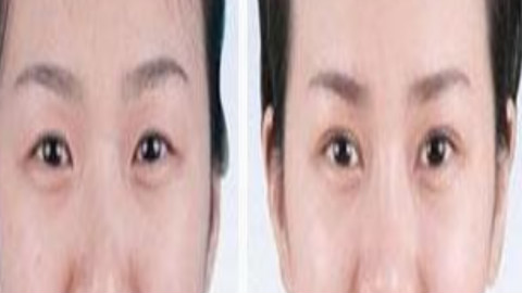 杭州艺星欧阳帆做双眼皮怎么样?双眼皮手术案例,真的很绝!