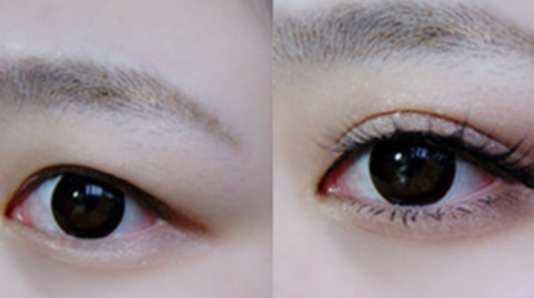 广州广美林勇双眼皮做的怎么样?双眼皮手术案例,水平很不错!