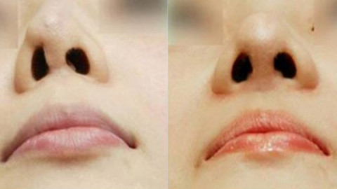 上海美联臣做鼻修复怎么样?上海美联臣鼻修复专家哪个比较厉害?