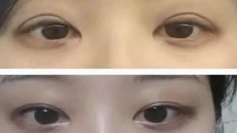 深圳北大医院做双眼皮修复怎么样?双眼皮修复好的医生推荐?技术很牛!