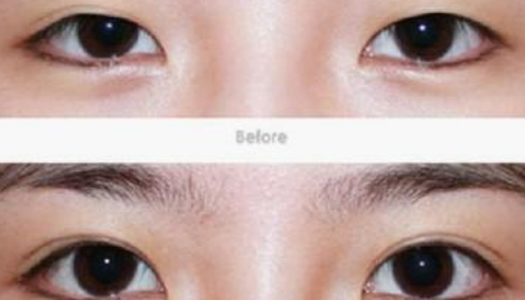 上海瑞金医院做双眼皮修复怎么样?修复双眼皮案例,精致且漂亮!