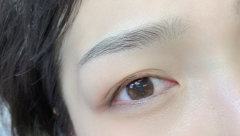 上海瑞金医院做双眼皮修复怎么样?修复双眼皮案例,精致且漂亮!