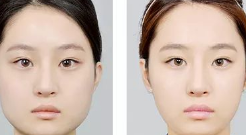 南京市第一医院做双眼皮怎么样?双眼皮手术案例及价格