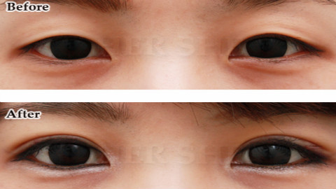 北京张海明做的双眼皮怎么样?北京张海明做的双眼皮案例,医生技术很不错!