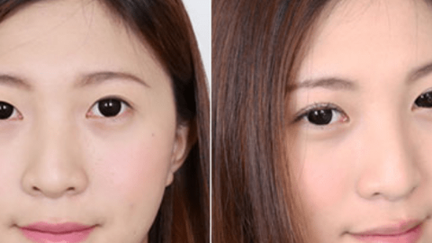 上海华美李健做双眼皮怎么样?上海华美李健做双眼皮案例,眼睛变好看!