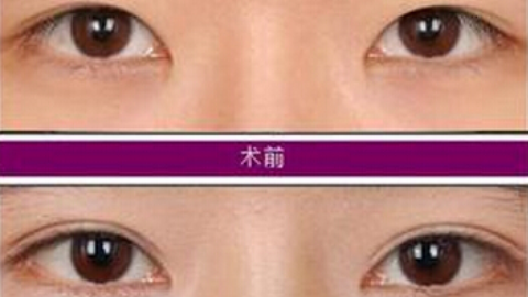 八大处刘暾做双眼皮修复怎么样?八大处刘暾做双眼皮修复案例及价格