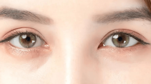 眼皮下垂会影响视力吗?怎么改良?
