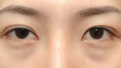 眼皮下垂会导致哪些症状?需要抽脂肪嘛?
