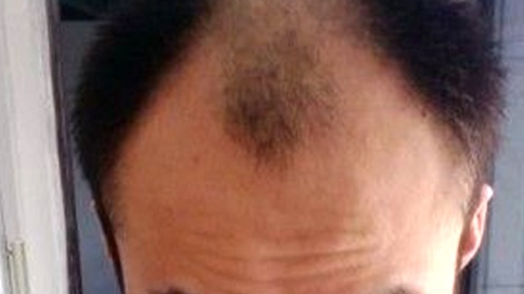 杭州正规毛发种植整形美容医生排名前三