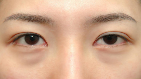 北京协和医院朱琳做双眼皮怎么样?北京协和医院朱琳做双眼皮案例,大眼很不错!