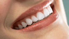 牙齿整形能不能走医保?可以报销吗?