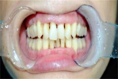 2021上海仁济医院牙齿正畸需要多少?牙齿正畸医生排名
